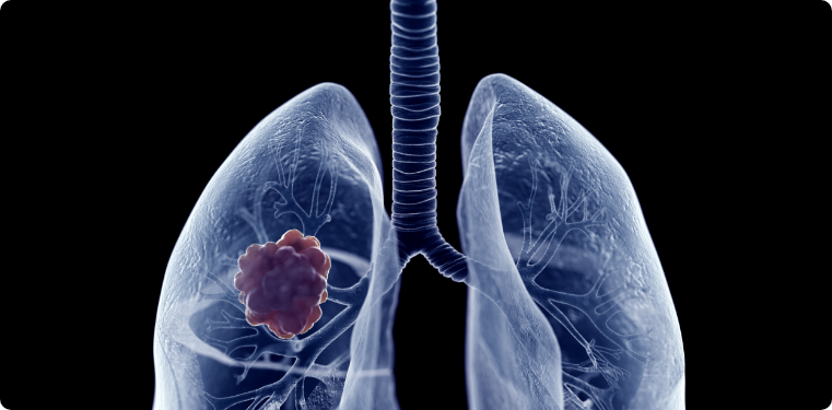 Imagem Câncer de pulmão