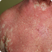 Síndrome de Sézary