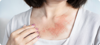 Vermelhidão difusa da pele 