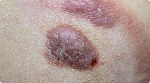 Linfomas cutâneos de células B (LCCB)1-3