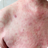 Micose fungoide (MF)